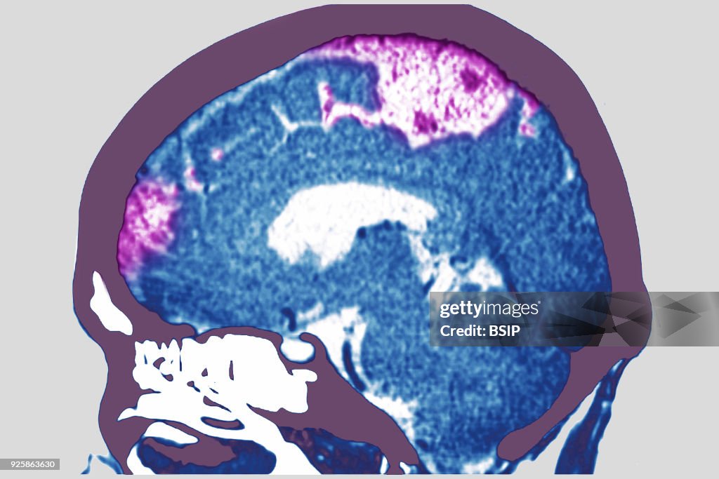 Cerebrovascular Accident