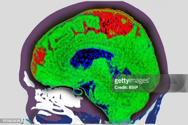 Cerebrovascular accident caused by thrombosis of an artery in the left hemisphere. Saggital plane cross-section brain scan.