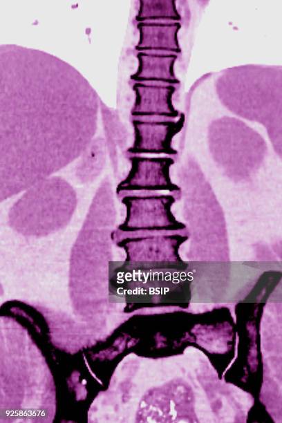 Vertebral osteoarthritis with osteophytes, bone spurs, seen on a frontal CT-scan of the lumbar vertebrae.