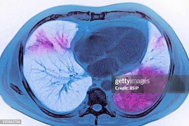 Acute pneumonia, seen on a cross-section thoracic CT-scan.