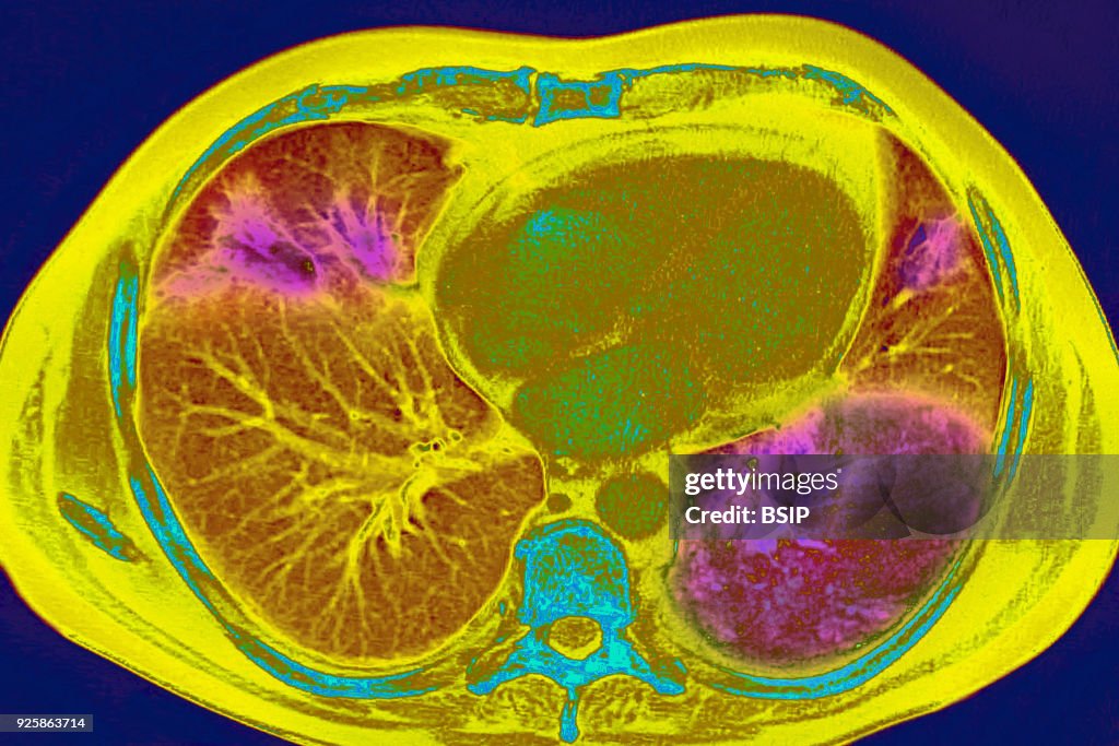 Pneumonia, Scan