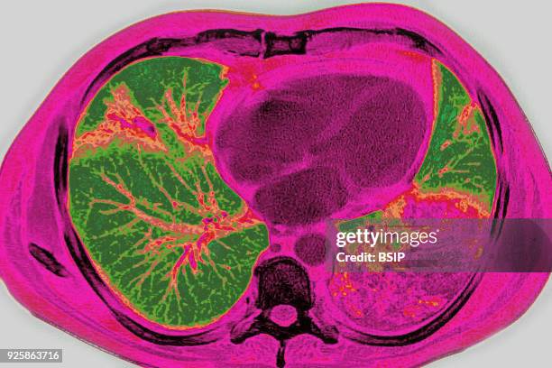 Acute pneumonia, seen on a cross-section thoracic CT-scan.