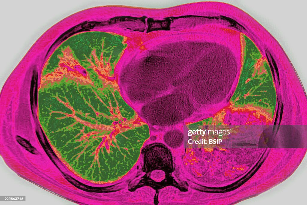 Pneumonia, Scan