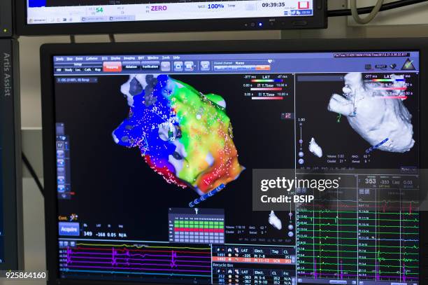 Radiofrequency ablation of cardiac arrhythmia using the Stereotaxis robotic system, by inserting a catheter into the heart, emitting radio waves that...