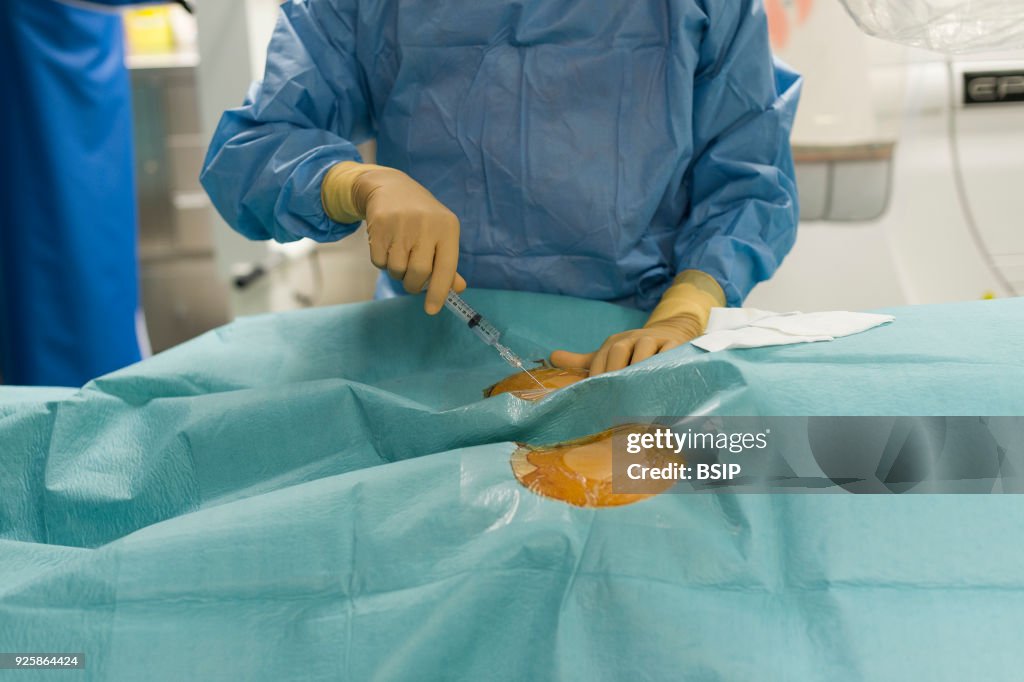 Radiofrequency Ablation