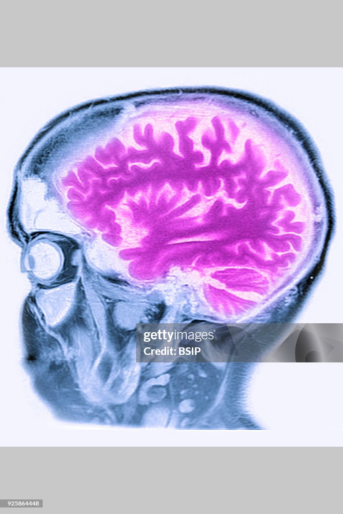 Cerebral Atrophy, MRI