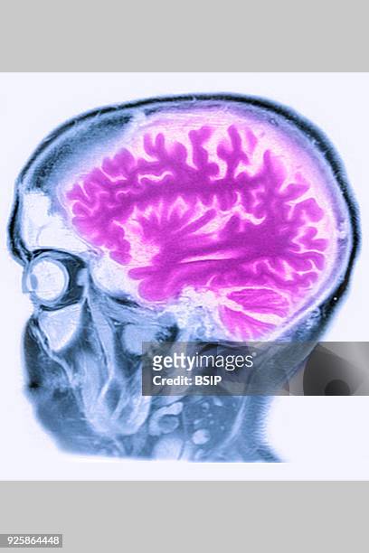 Cerebral atrophy, anterior temporal and parietal frontal Ponto cerebellar, saggital plane MRI cranial scan.