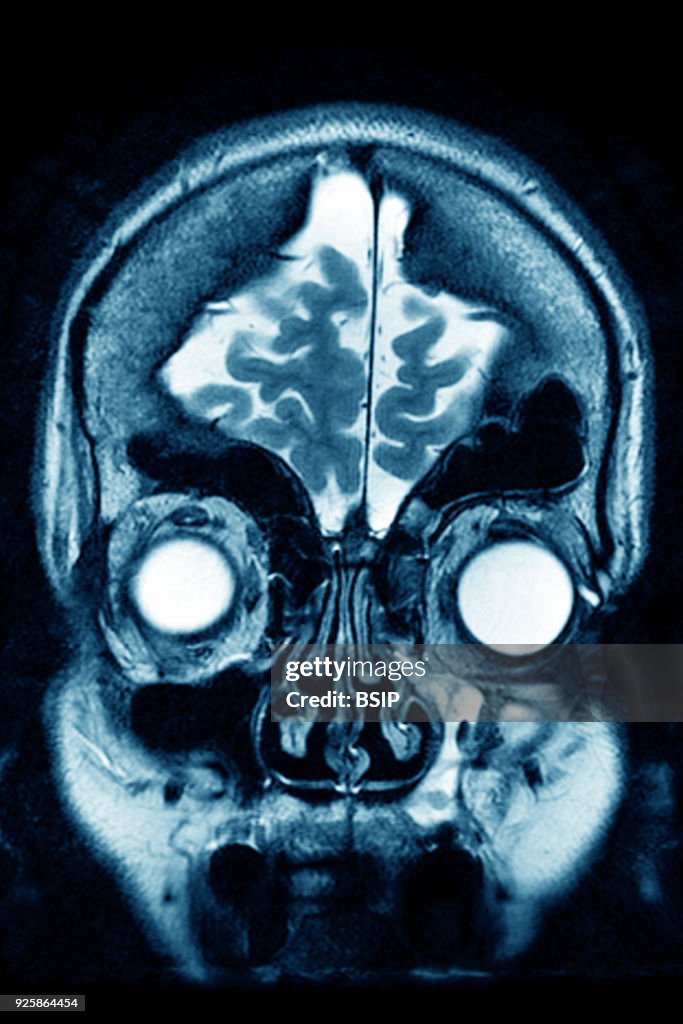 Cerebral Atrophy, MRI