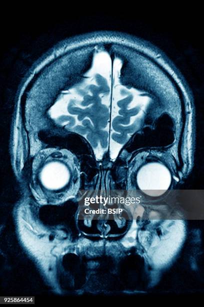 Cerebral atrophy, anterior temporal and parietal frontal Ponto cerebellar, frontal cross-section MRI cranial scan.