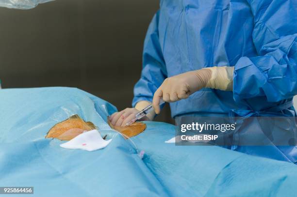 Radiofrequency ablation of cardiac arrhythmia using the Stereotaxis robotic system, by inserting a catheter into the heart, emitting radio waves that...