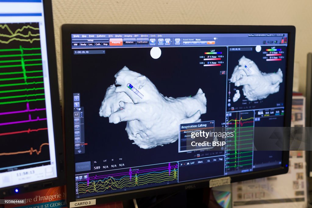 Radiofrequency Ablation