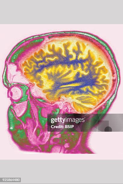 Cerebral atrophy, anterior temporal and parietal frontal Ponto cerebellar, saggital plane MRI cranial scan.