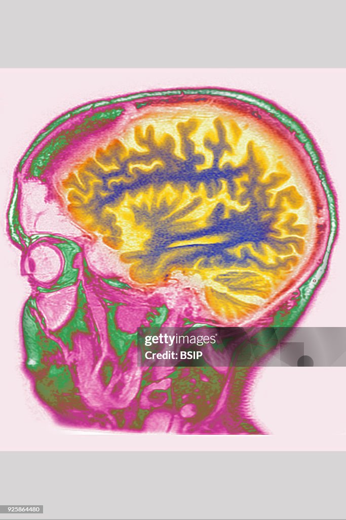 Cerebral Atrophy, MRI