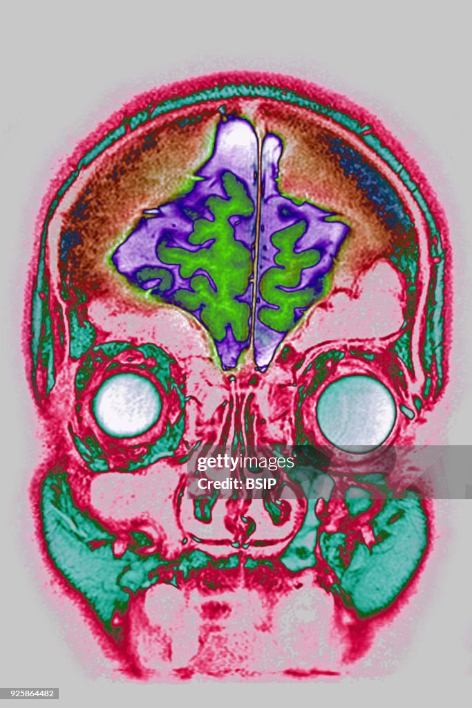 Cerebral Atrophy, MRI