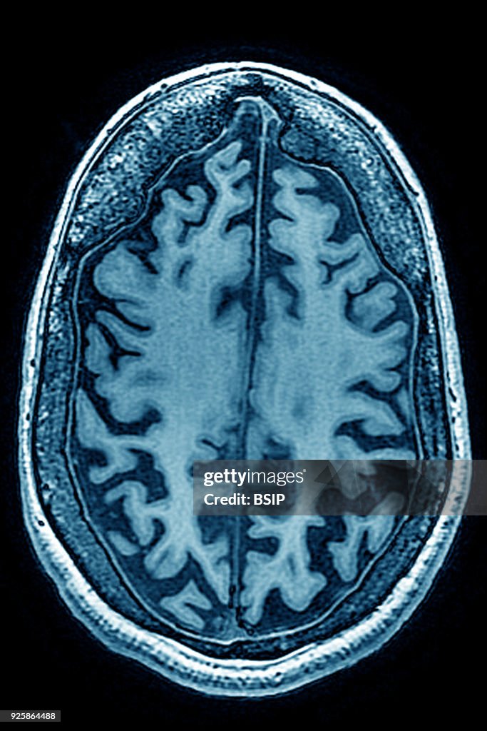 Cerebral Atrophy, MRI