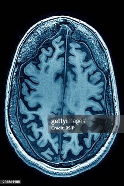 Cerebral atrophy, anterior temporal and parietal frontal Ponto cerebellar, radial cross-section MRI cranial scan.