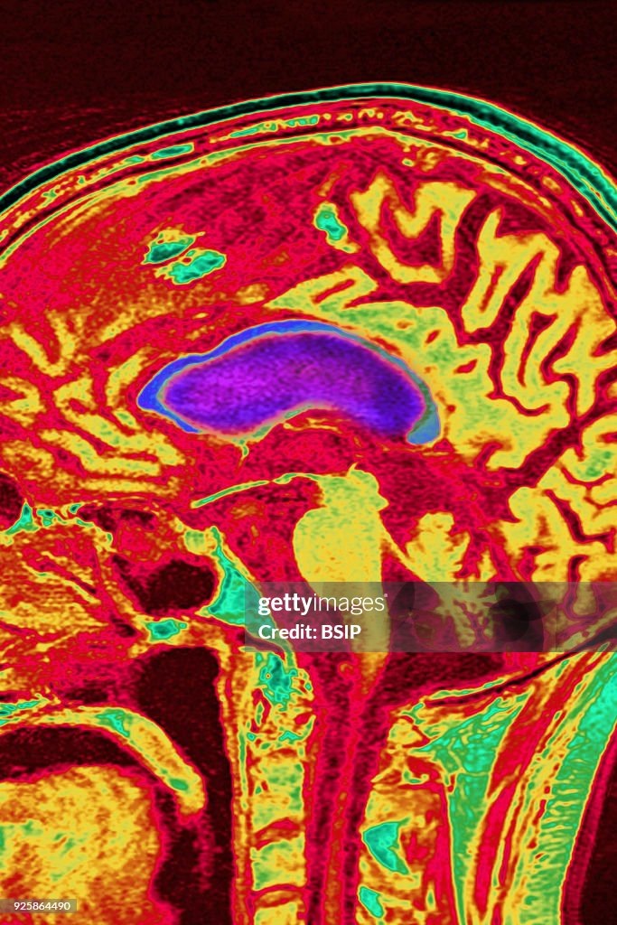 Cerebral Atrophy, MRI