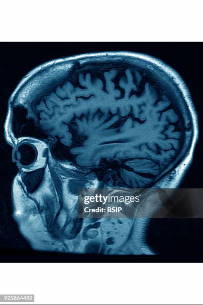 Cerebral atrophy, anterior temporal and parietal frontal Ponto cerebellar, saggital plane MRI cranial scan.