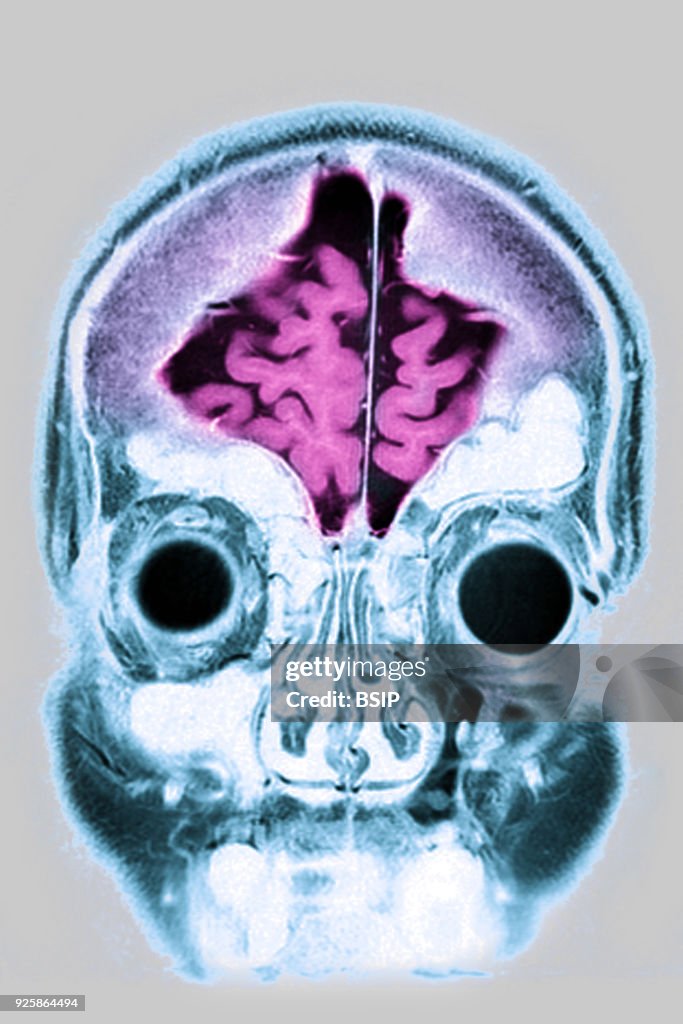 Cerebral Atrophy, MRI