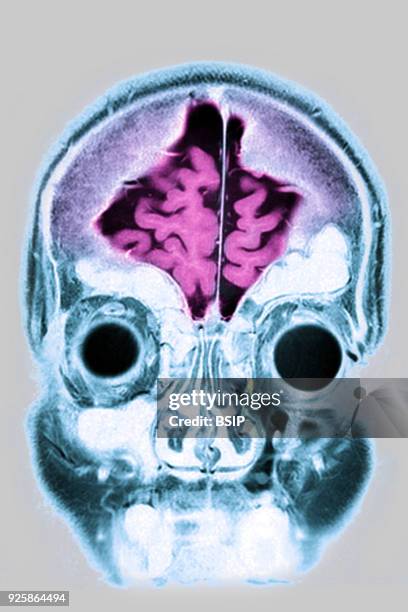 Cerebral atrophy, anterior temporal and parietal frontal Ponto cerebellar, frontal cross-section MRI cranial scan.