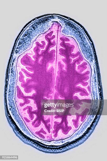 Cerebral atrophy, anterior temporal and parietal frontal Ponto cerebellar, radial cross-section MRI cranial scan.