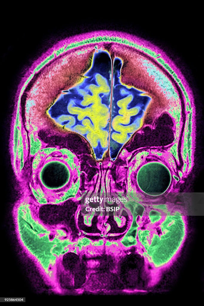 Cerebral Atrophy, MRI