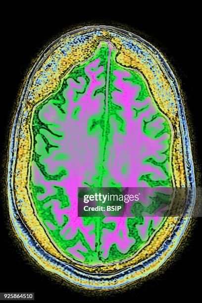 Cerebral atrophy, anterior temporal and parietal frontal Ponto cerebellar, radial cross-section MRI cranial scan.