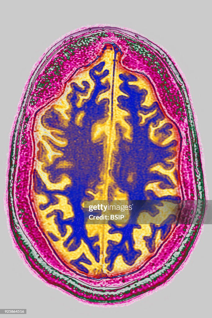 Cerebral Atrophy, MRI