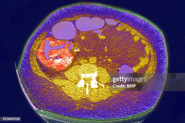 Colon cancer, tumor on the caecum and ileocolic valve, Visualization on a radial CT scan.