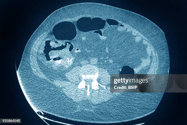 Colon cancer, tumor on the caecum and ileocolic valve, Visualization on a radial CT scan.