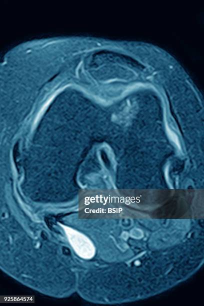 Osseous edema of the knee. Subcortical lesion of the condyle, radial cross-section MRI scan of the knee.