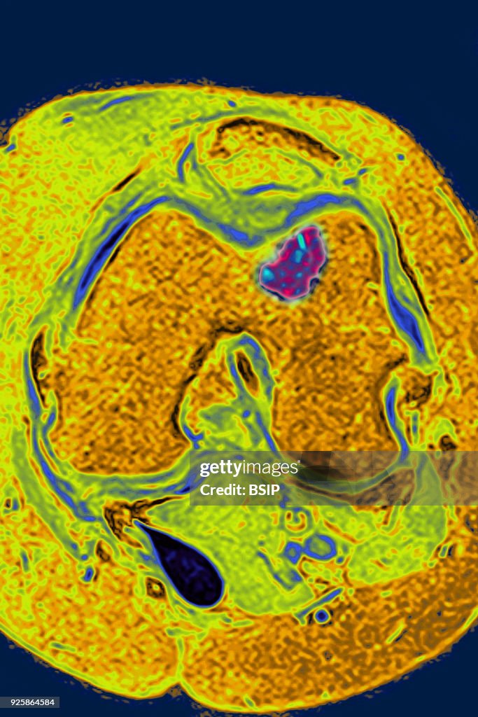 Osseous Edema MRI