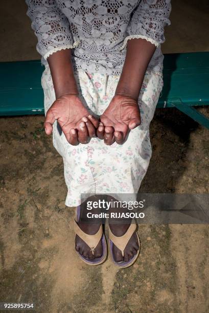 Leprosy diagnosed Vololonirina Ranorovelo poses for a photograph at the leprosy treatment center of Moramanga on February 28, 2018. Infected by the...