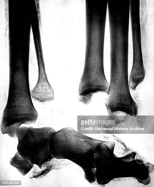 Ray images of the legs of an ancient Egyptian mummy created soon after the announcement of Wilhelm Rontgen's discovery of X-rays. Wilhelm Rontgen a...