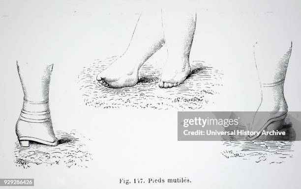 Engraving depicting damaged feet caused by foot binding in China. Dated 19th Century.