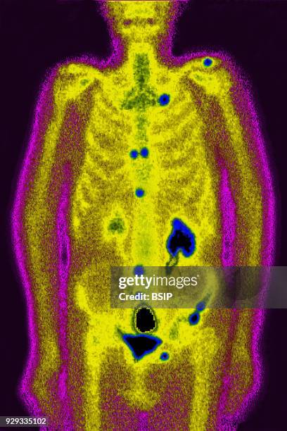Prostate cancer, adenocarcinoma, with metastases, seen on a frontal scintiscan.