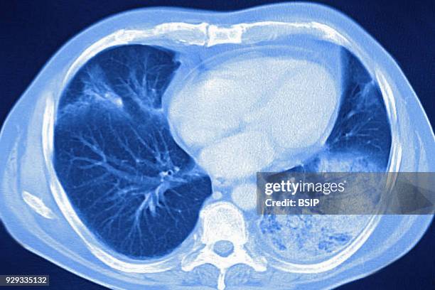 Acute pneumonia, seen on a cross-section thoracic CT-scan.