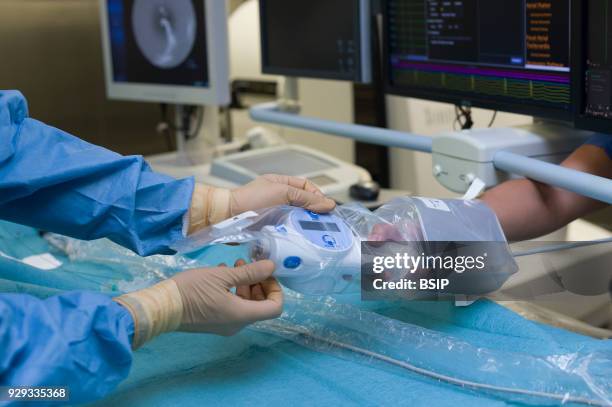 Radiofrequency ablation of cardiac arrhythmia using the Stereotaxis robotic system, by inserting a catheter into the heart, emitting radio waves that...