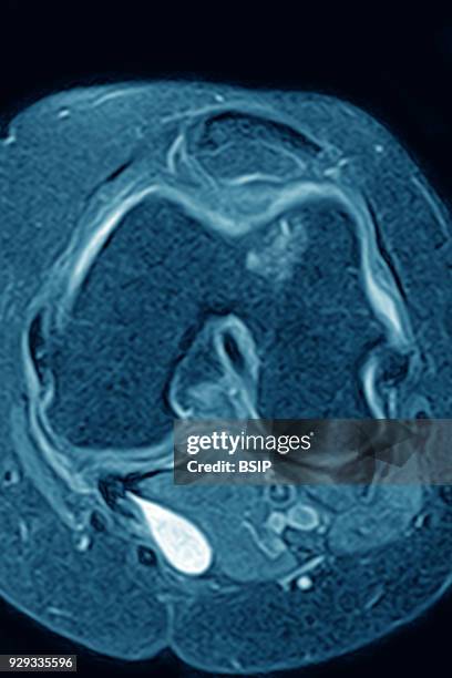 Osseous edema of the knee. Subcortical lesion of the condyle, radial cross-section MRI scan of the knee.