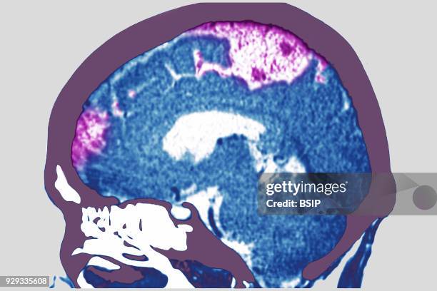 Cerebrovascular accident caused by thrombosis of an artery in the left hemisphere. Saggital plane cross-section brain scan.
