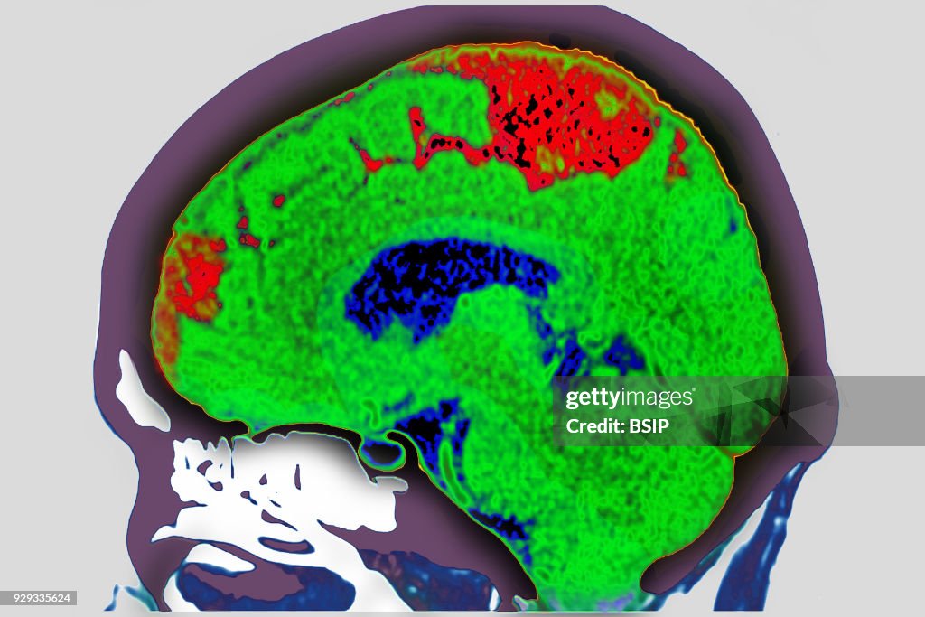 Cerebrovascular Accident