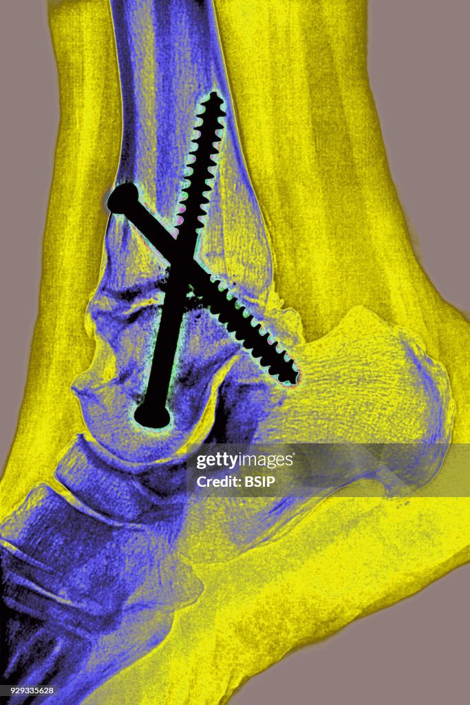 Ankle Osteosynthesis, X-Ray