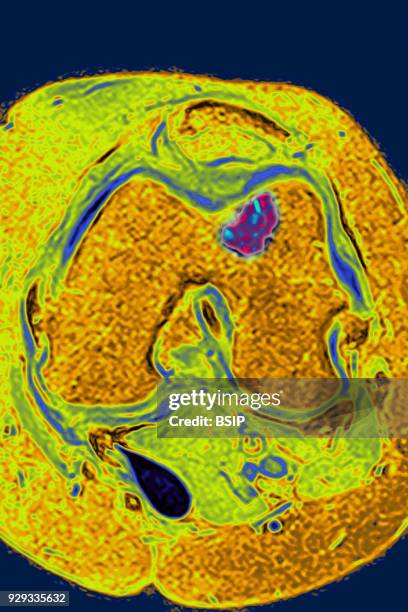 Osseous edema of the knee. Subcortical lesion of the condyle, radial cross-section MRI scan of the knee.