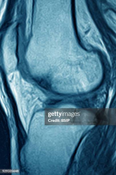 Osseous edema of the knee. Subcortical lesion of the condyle, saggital cross-section MRI scan of the knee.