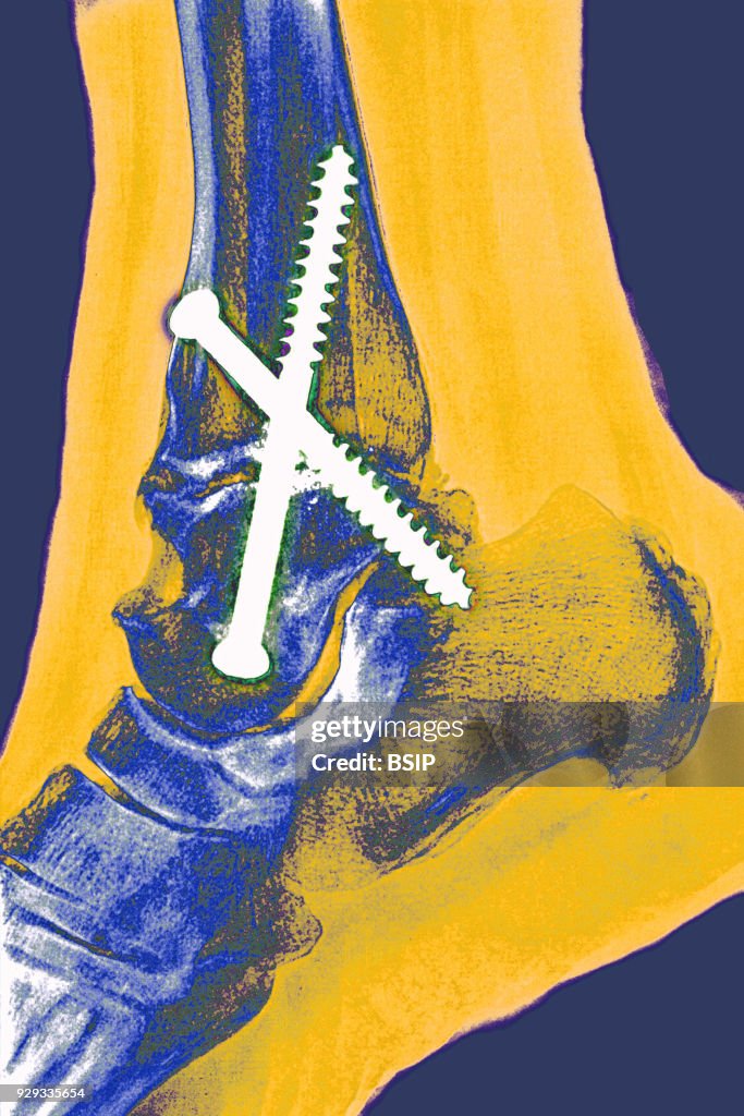 Ankle Osteosynthesis, X-Ray