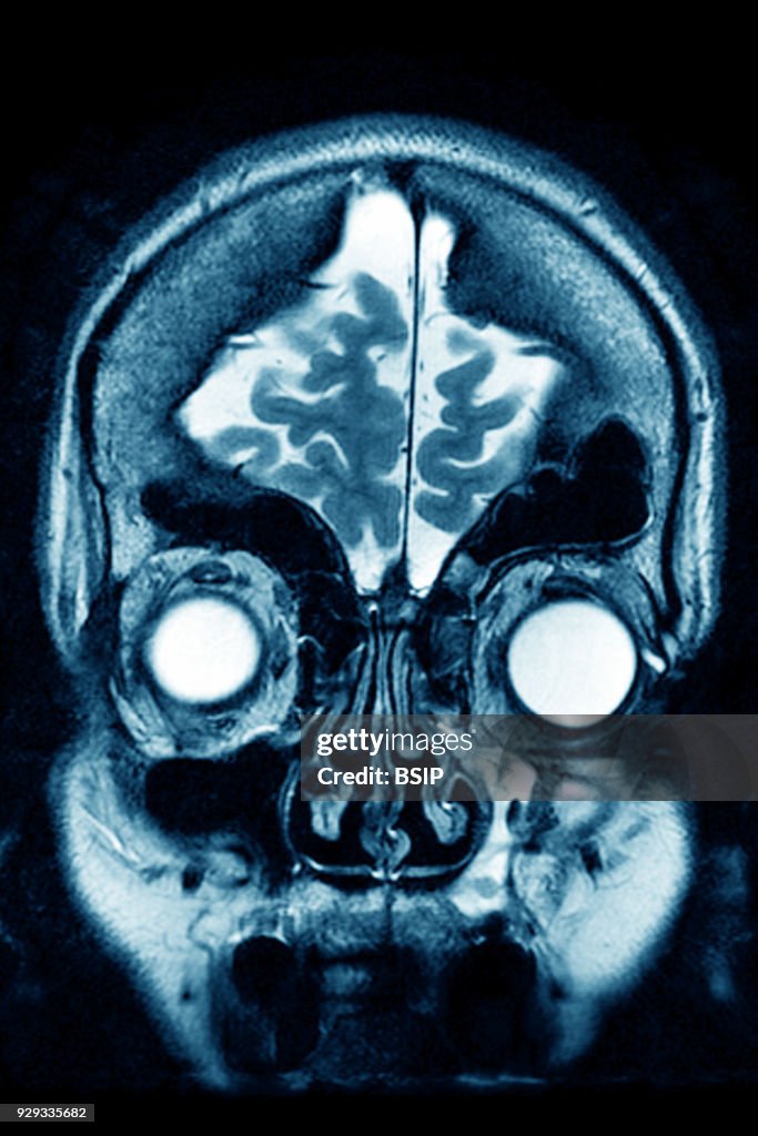 Cerebral Atrophy, MRI