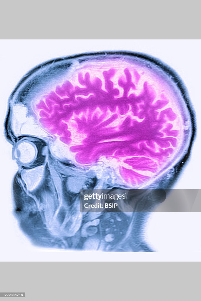 Cerebral Atrophy, MRI