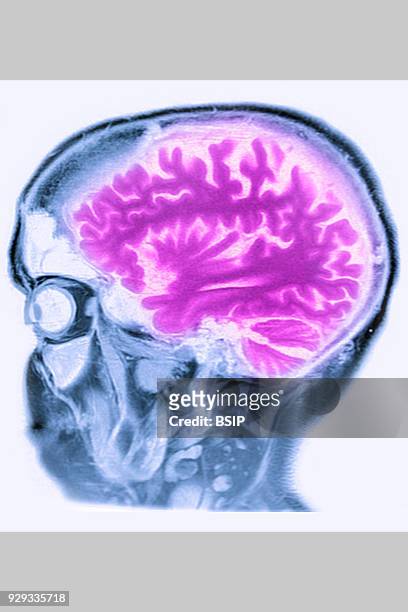 Cerebral atrophy, anterior temporal and parietal frontal Ponto cerebellar, saggital plane MRI cranial scan.