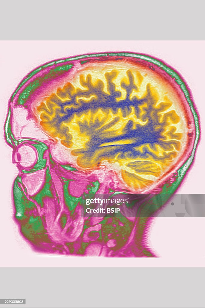 Cerebral Atrophy, MRI