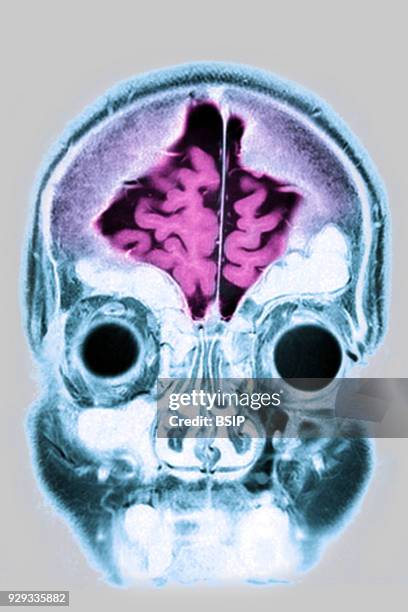 Cerebral atrophy, anterior temporal and parietal frontal Ponto cerebellar, frontal cross-section MRI cranial scan.